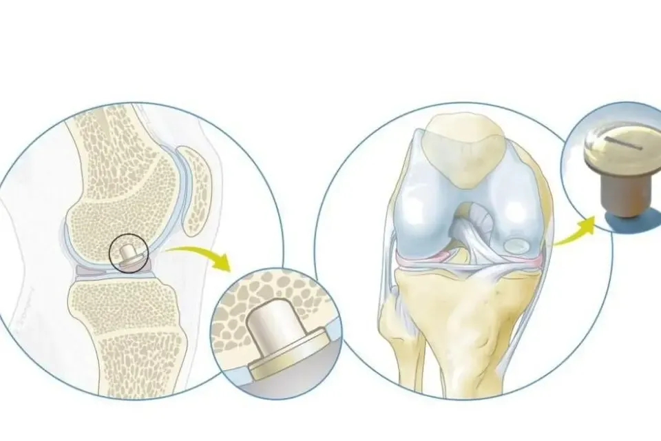 SyCap implant from Avalanche Medical